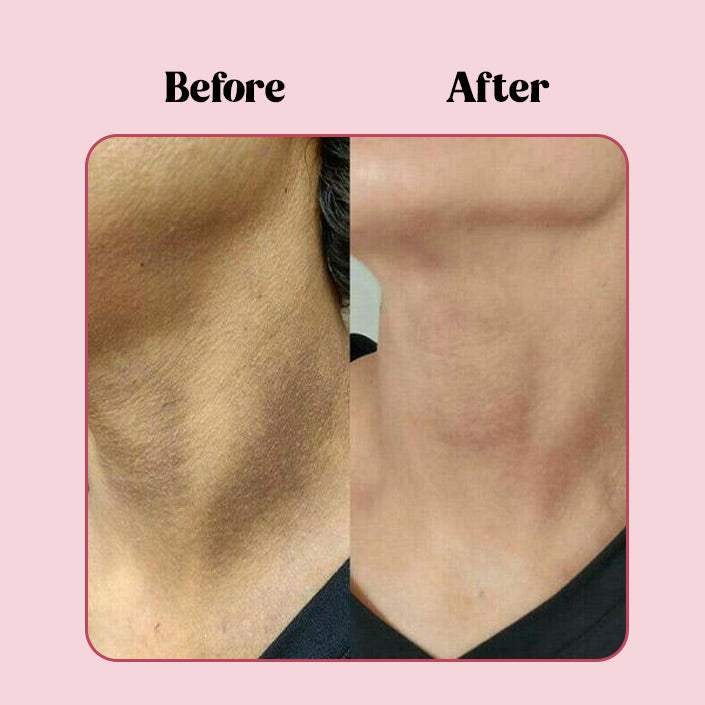 Dark Spots Removing Cream